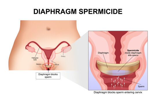 Diaphragm spermicide woman contraceptive cup illustration