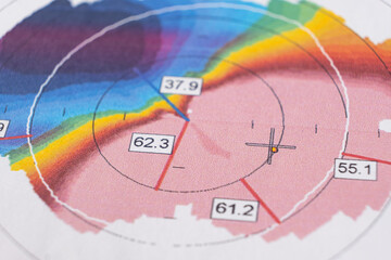 Results of the examination of the thickness and curvature of the cornea in a patient with keratoconus.