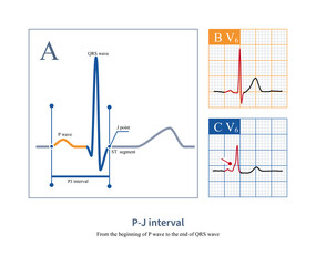 On the electrocardiogram, the PJ interval is used to distinguish between ventricular heartbeats and ventricular pre excitation. The normal value of PJ interval is less than 270ms.
