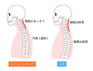 正常とストレートネックの上半身の説明入り比較イラスト