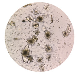 Uric acid crystals and calcium oxalate monohydrate under microscope