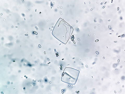 Uric acid crystals and calcium oxalate monohydrate under microscope