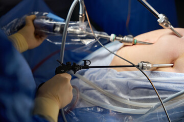 Obesity surgery. Weight loss surgery with laparoscopy technique