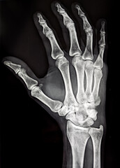  X ray of hand showing fifth metacarpal fracture, a common sports injury called boxer’s fracture 