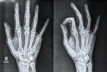  X ray of hand showing fifth metacarpal fracture, a common sports injury called boxer’s fracture 