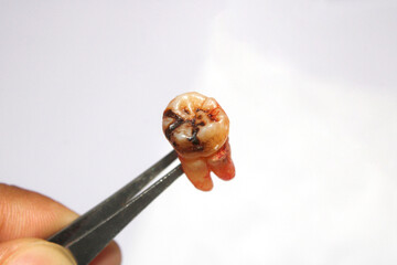 Wisdom teeth cause problems in the mouth.