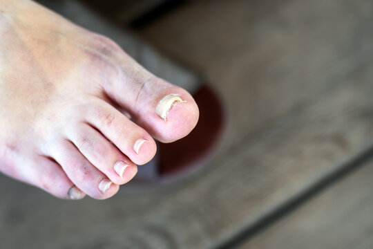 A damaged toenail after a fungal disease