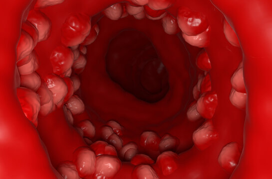 Ulcerative colitis (UC) - section view 3d illustration