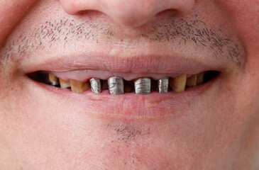 Crooked metal teeth in the mouth. Close-up