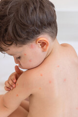 kid back with lot of insects bites,mosquito or fleas, red spots. lying baby boy on pillow and...