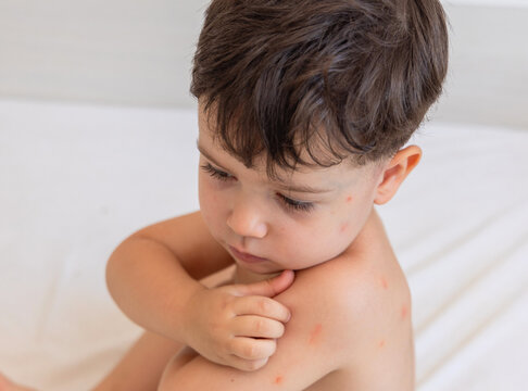 kid back with lot of insects bites,mosquito or fleas, red spots. lying baby boy on pillow and mother,woman hand applying gel,cream. child scratches his skin, feeling discomfort. summer issues