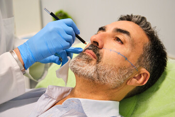 A man is getting a cheekbone filler or cheek Botox. The doctor is using a pen to draw a line on the...