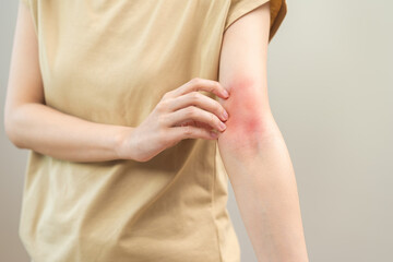 Dermatology asian young woman, girl allergy, allergic reaction from atopic, insect bites on her arm, hand in scratching itchy, itch red spot or rash of skin. Healthcare, treatment of beauty.