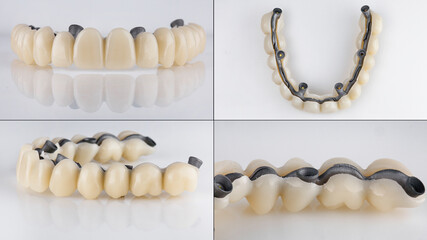 dental collage of a temporary upper jaw prosthesis with a beam from different angles © Dental Pro Content