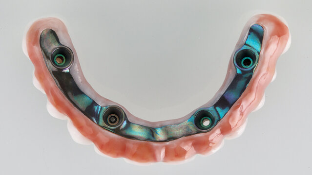 titanium beam in a zircon prosthesis with gum, top view on a white background