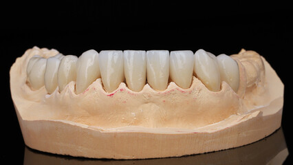 ceramic crowns on a lower jaw model on a black background