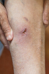 Fototapeta premium Deep 1 cm size wound on a old woman's leg