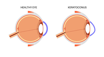 Cataract eye disease