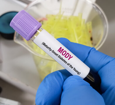 Blood sample for MODY or Maturity-Onset Diabetes of the Young test to diagnose neonatal diabetes (ND) in a symptomatic individual.