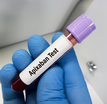 Blood sample for Apixaban level test. Measurement of drug level in order to monitor therapeutic level and diagnose under-dosage or potential toxicity.