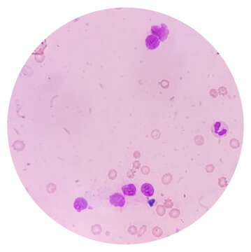 Bone marrow study (BMS). Secondary metastasis  in bone marrow. Cancer cell. Oncology, cancerology, Bone marrow (BM) metastasis (BMM).