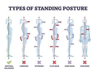 Types of standing postures and medical back pathology set outline diagram, transparent background. Educational labeled collection.