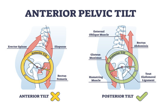 Anterior pelvic tilt model compared with posterior labeled outline diagram, transparent background. Educational scheme with skeletal bone location and movement angle illustration.
