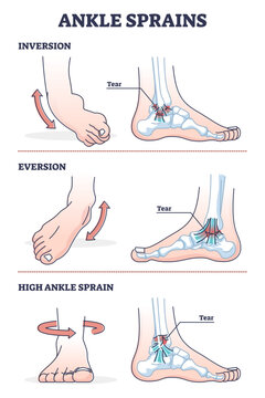 Ankle sprains situations with inversion and eversion injury outline diagram, transparent background. Twisted foot or leg pain and swollen inflammation cause.