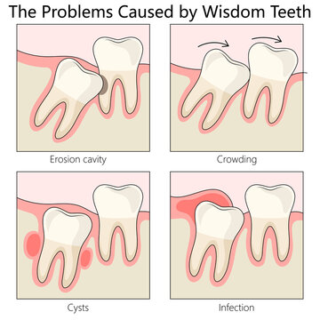 issues caused by wisdom teeth. Highlights dental problems and the need for treatment diagram hand drawn schematic raster illustration. Medical science educational illustration