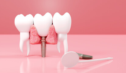 Dental Implants surgery concept, dentistry denture, Dental denture on pink background. 3D render.