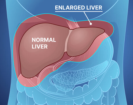 Hepatomegaly. Normal liver, enlarged liver. Liver disease. Healthcare illustration. Vector illustration.