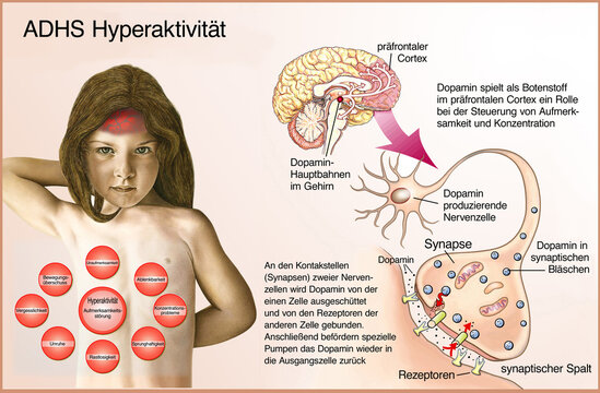 ADHS-Hyperaktivitaet