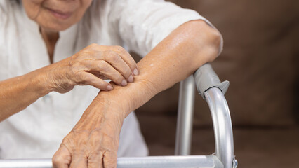 Elderly woman itchy and scratching arm because dry skin.