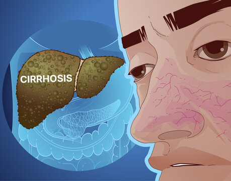 Vascular spider. Signs of liver cirrhosis. Signs of liver disease. Healthcare illustration. Vector illustration.