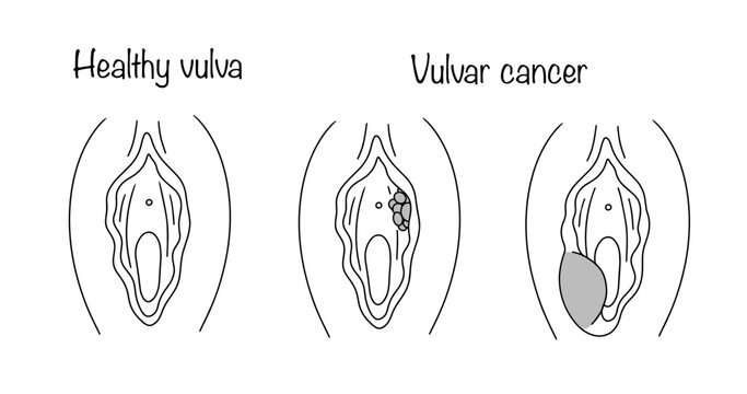 Vulvar cancer