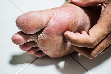 Men's feet with fungus, The skin peels off into wounds, Athlete's Foot, Tinea pedis, Fungal...