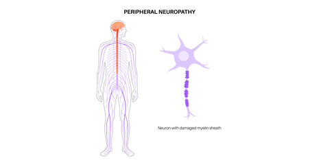 Peripheral neuropathy medical poster