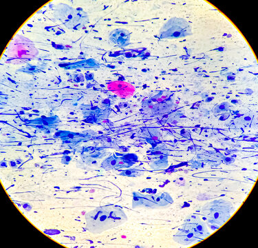 Pap's smear. Inflammatory smear with HPV related changes. Cervical cancer. SCC zooming micrograph.