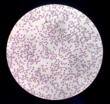Anisocytosis anisochromia with both microcytic hypochromic and macrocytic hypochromic RBC with rouleaux formation, Dimorphic anemia