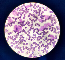 Acute leukemia, ALL(Acute lymphoblastic leukemia), peripheral blood smear, Under 100x light microscope to diagnosis of Acute leukemia.