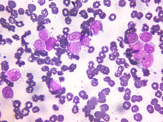Acute leukemia, ALL(Acute lymphoblastic leukemia), peripheral blood smear, Under 100x light...