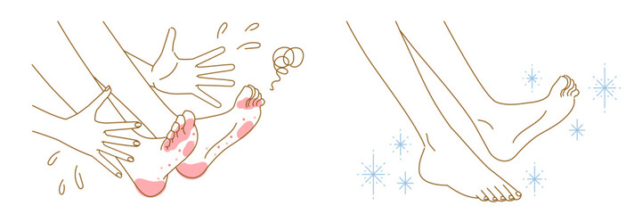 水虫や魚の目、タコ：女性の足のイメージイラストセット