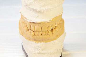 Malocclusion teeth. Plaster Dental model with jaws. Cast of teeth.
