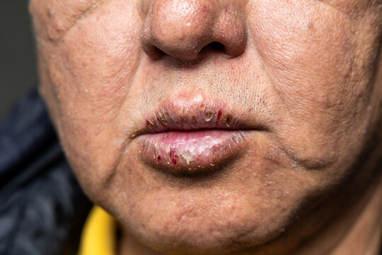 Closeup of elderly Asian man with dry face and chapped cracked lips with dryness during winter without protection