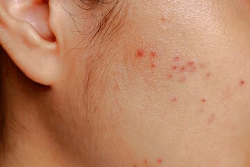 Asian woman facial skin with red spots and swelling after acne laser  treatment and popping by...