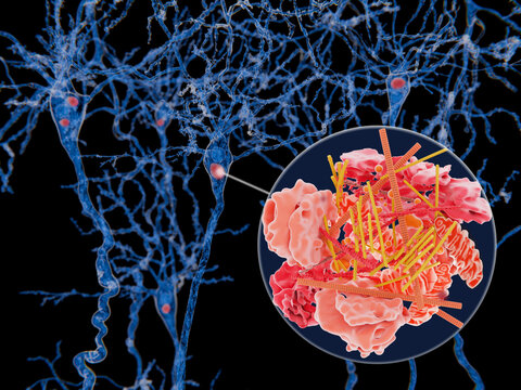 Neurons with Lewy bodies