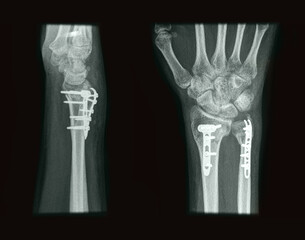 X-ray of distal radius fractures with titanium plate and screws