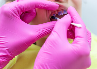 Dentist applying plaque disclosing solution to child's teeth