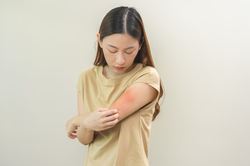 Dermatology asian young woman, girl allergy, allergic reaction from atopic, insect bites on her...