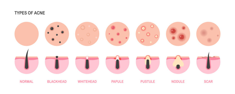 Stages of acne development. Acne of types and skin disease: skin pimples, face comedones, blackheads.